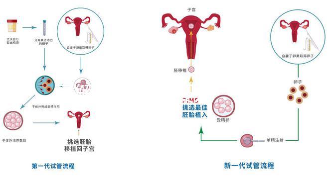 了解二代試管嬰兒:技術原理與優(yōu)勢解析