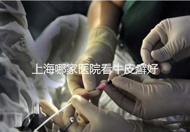 上海哪家醫院看牛皮癬好（上海治銀屑病最好的醫院）