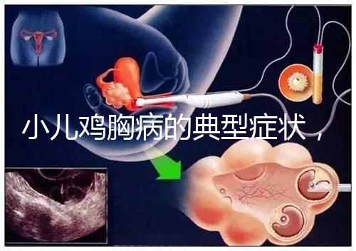 小兒雞胸病的典型癥狀，早發現早治療很重要！